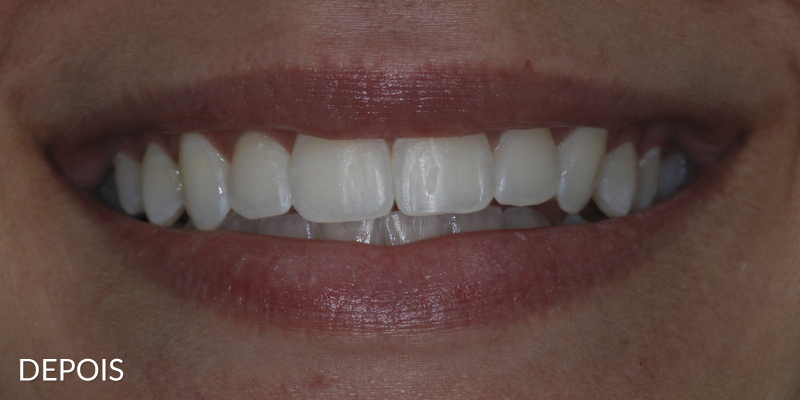 clareamento_dental_depois